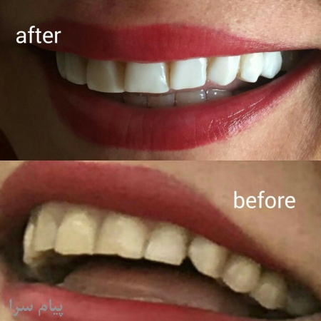 دندانپزشک در ملاصدرا اصلاح طرح لبخند ، عصب کشی، پرکردن دندان
