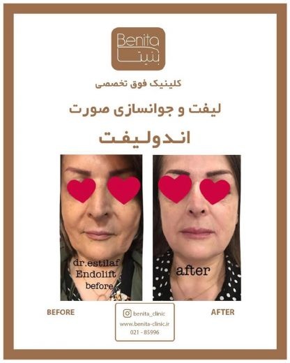 قیمت لاغری با ترواسکالپ