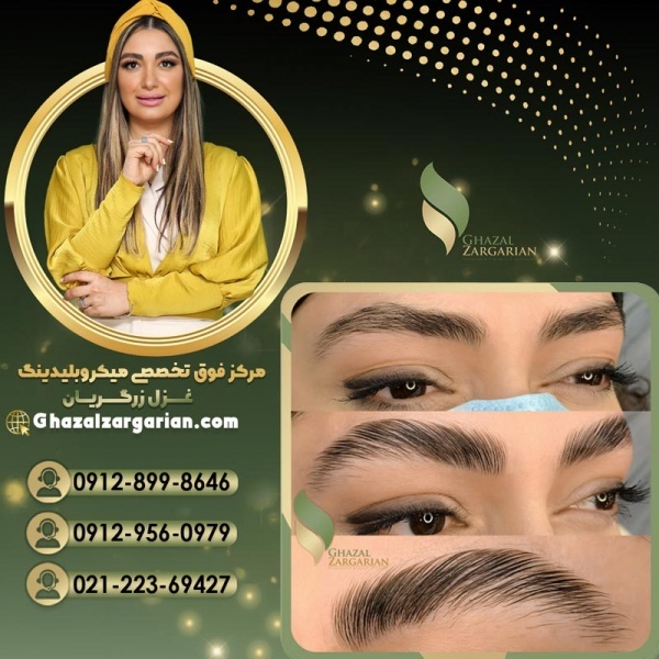 هزینه لیفت ابرو با مواد در مرکز غزل زرگریان